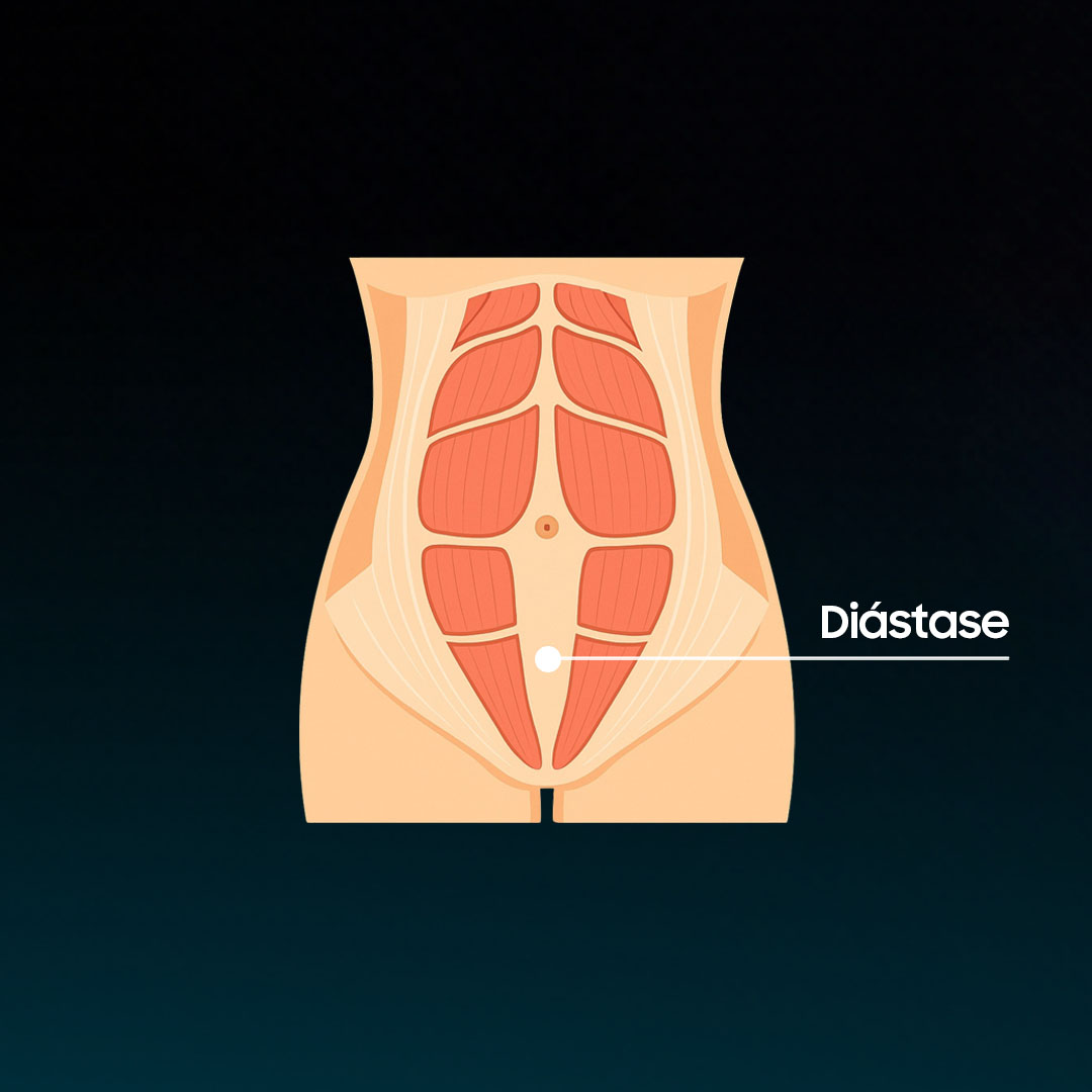 Representação da diástase abdominal: afastamento da linha alba e dos músculos retos abdominais